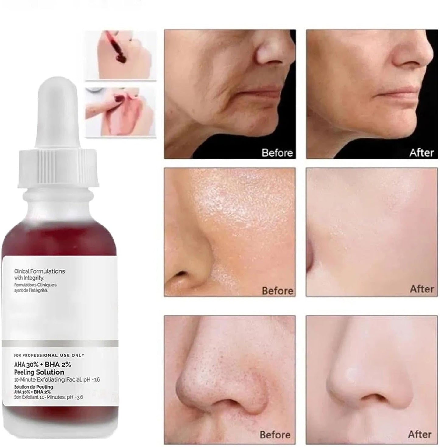 AHA 30% + BHA2% Peeling Solution
