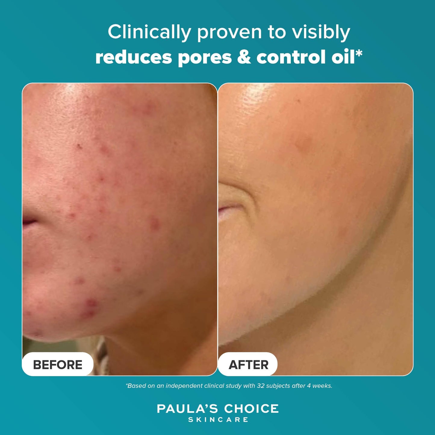 Paula's Choice SKIN PERFECTING 2% BHA Liquid Exfoliant