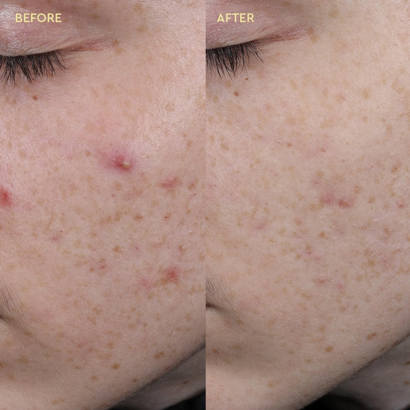 BYOMA Blemish Clearing Paste – For Sensitive Skin, Reduces Redness, Clears Active Blemishes & Fades Post-Blemish Marks, with Salicylic Acid for Smooth, Healthy Skin